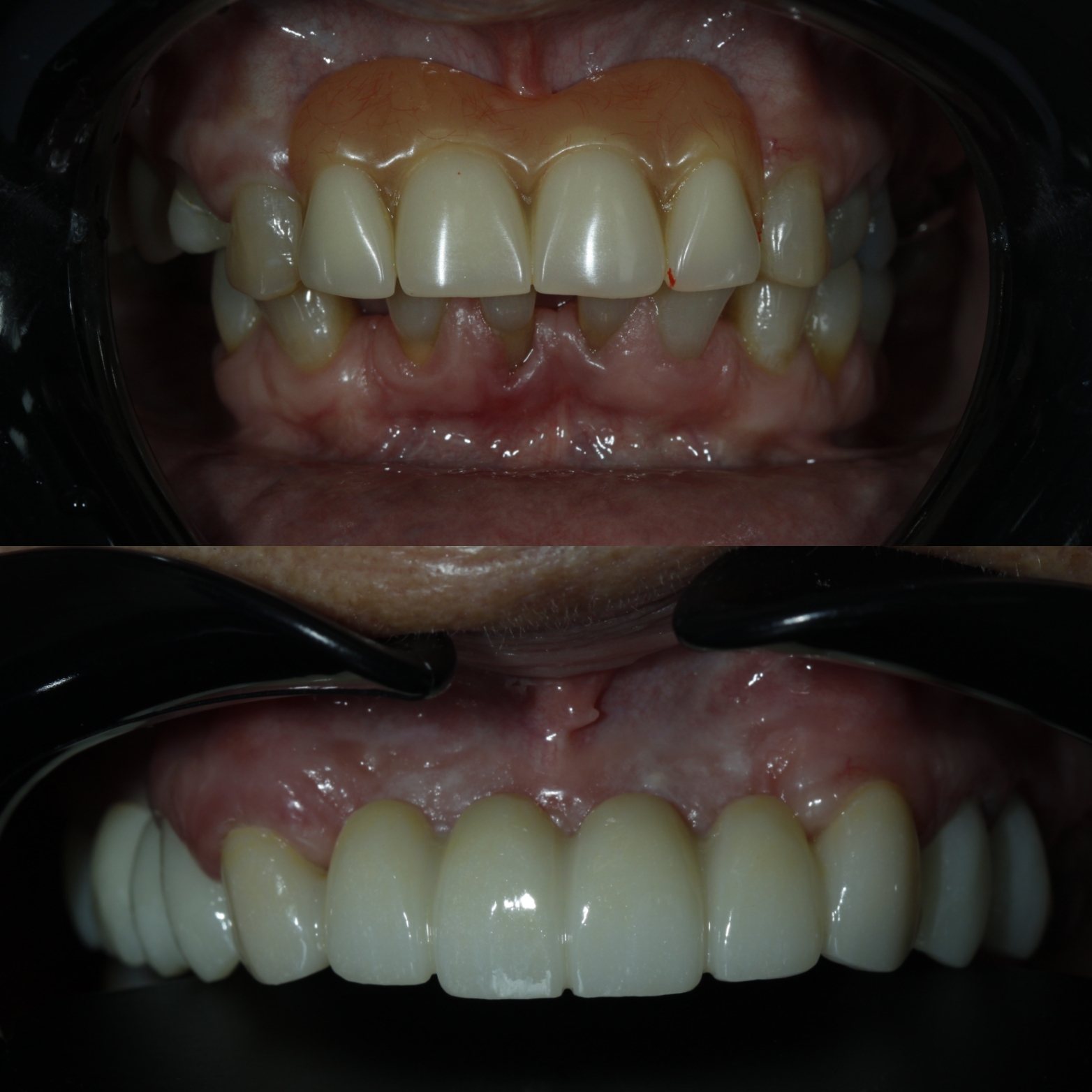 Dental Crowns & Bridges — case photo 1 at NIS Dental Image, Patong Phuket