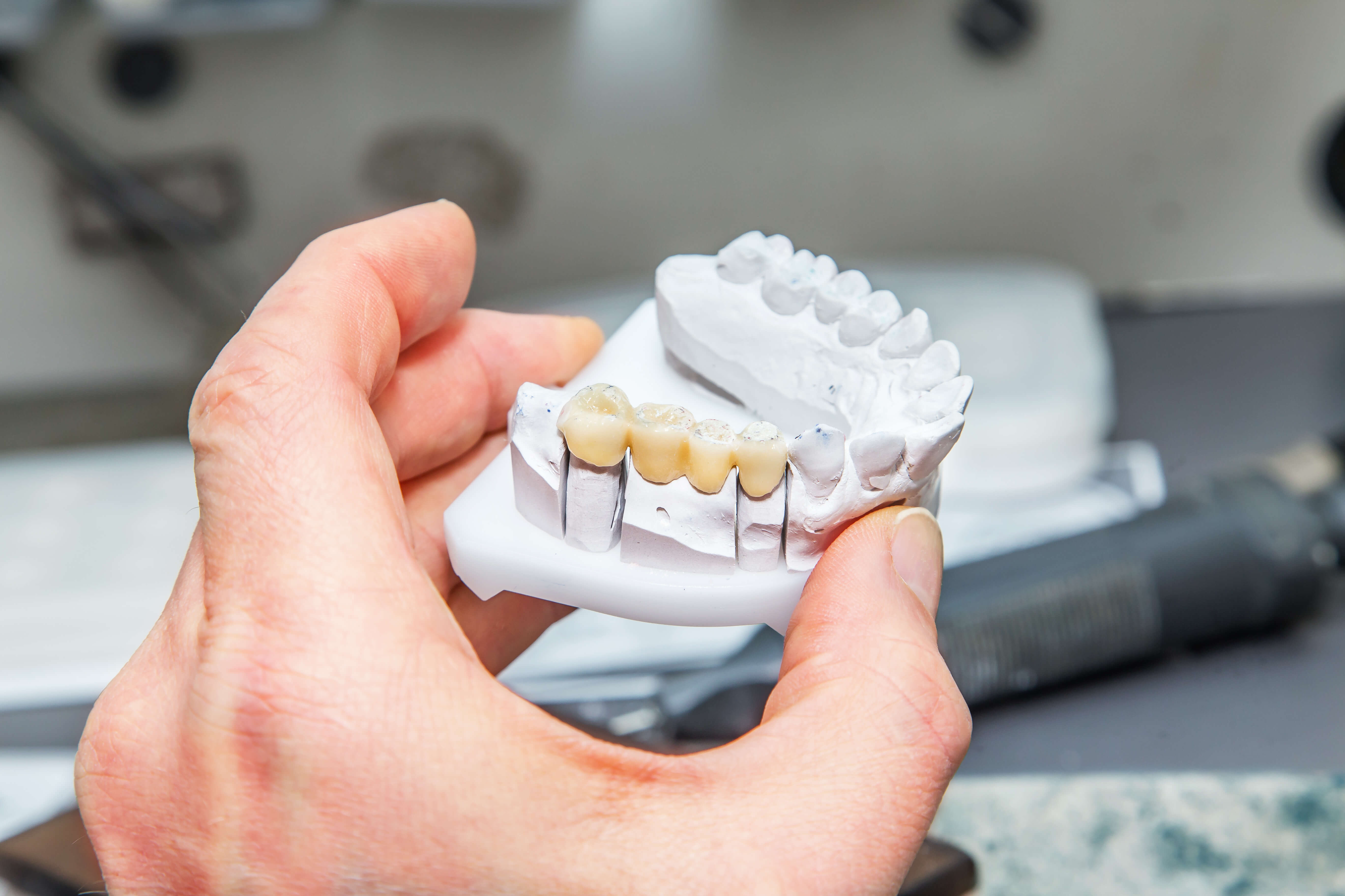 Dental Crowns & Bridges at NIS Dental Image, Patong Phuket