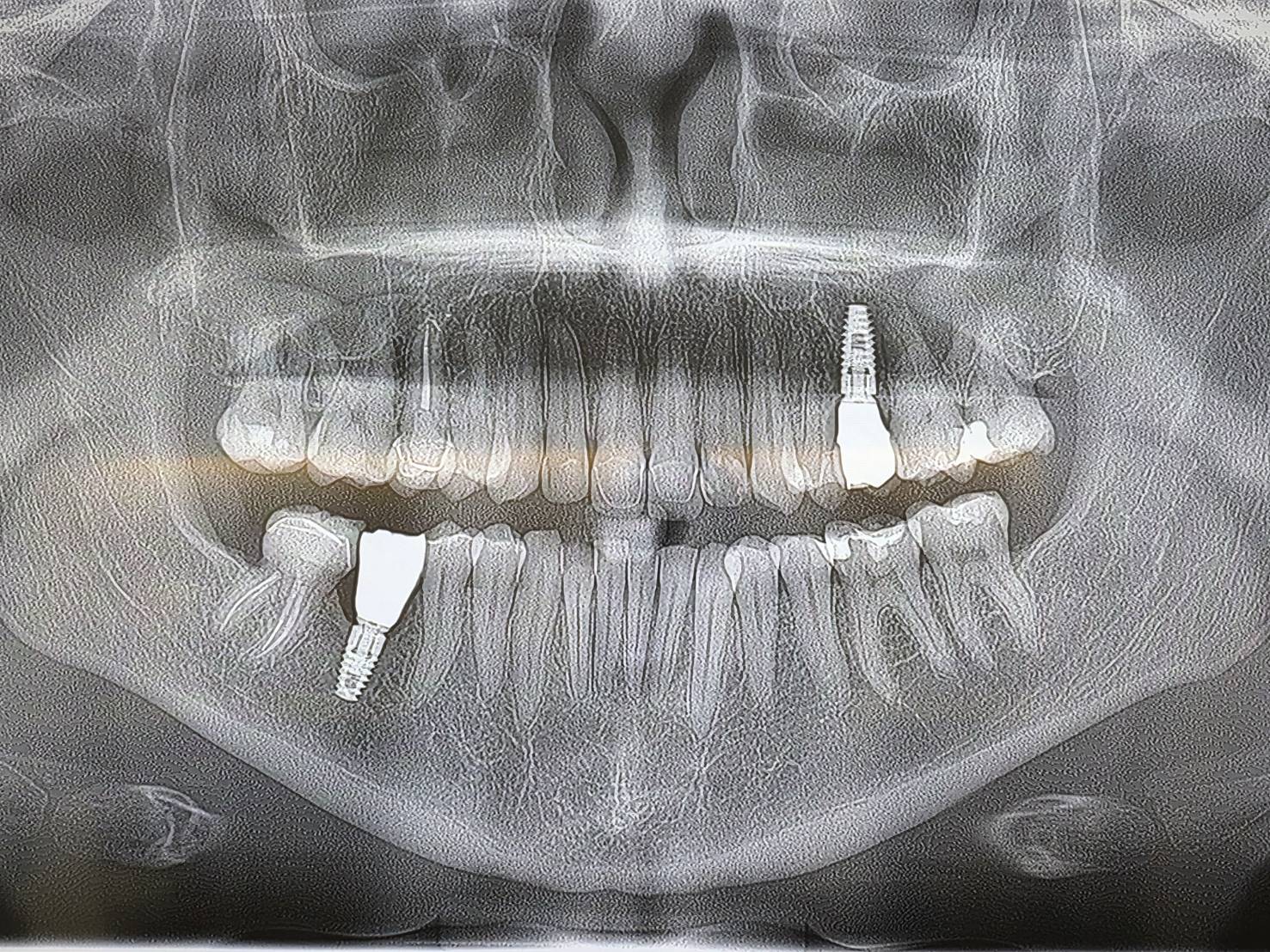 Teeth Whitening — case photo 1 at NIS Dental Image, Patong Phuket