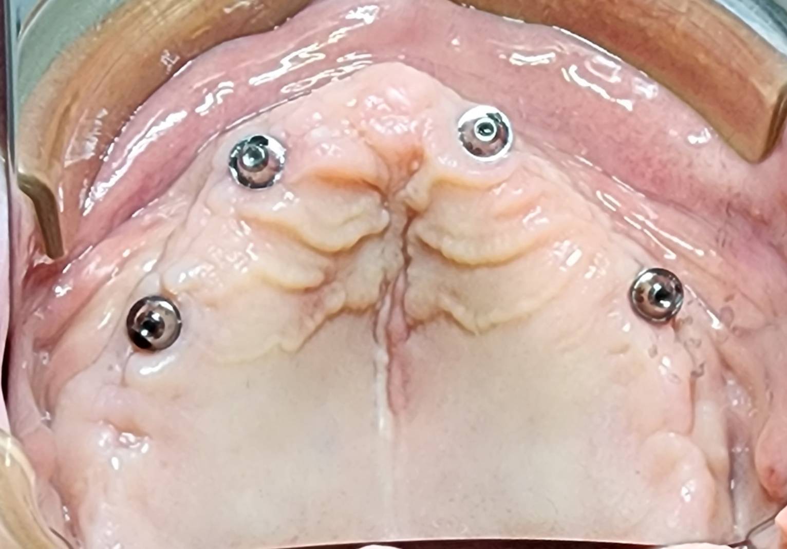 All-on-4 & All-on-6 Dental Implants — case photo 4 at NIS Dental Image, Patong Phuket