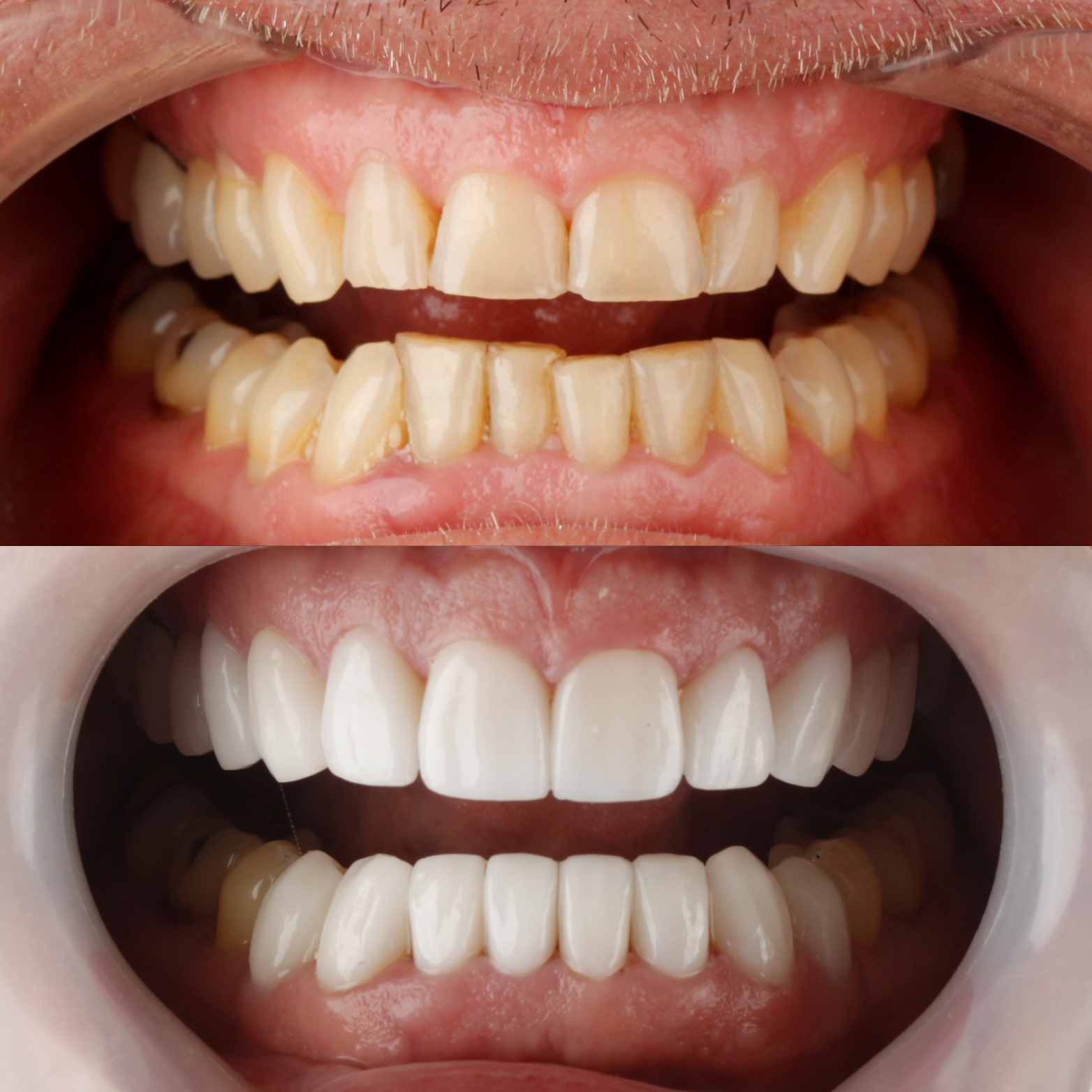 Dental Veneers — case photo 1 at NIS Dental Image, Patong Phuket