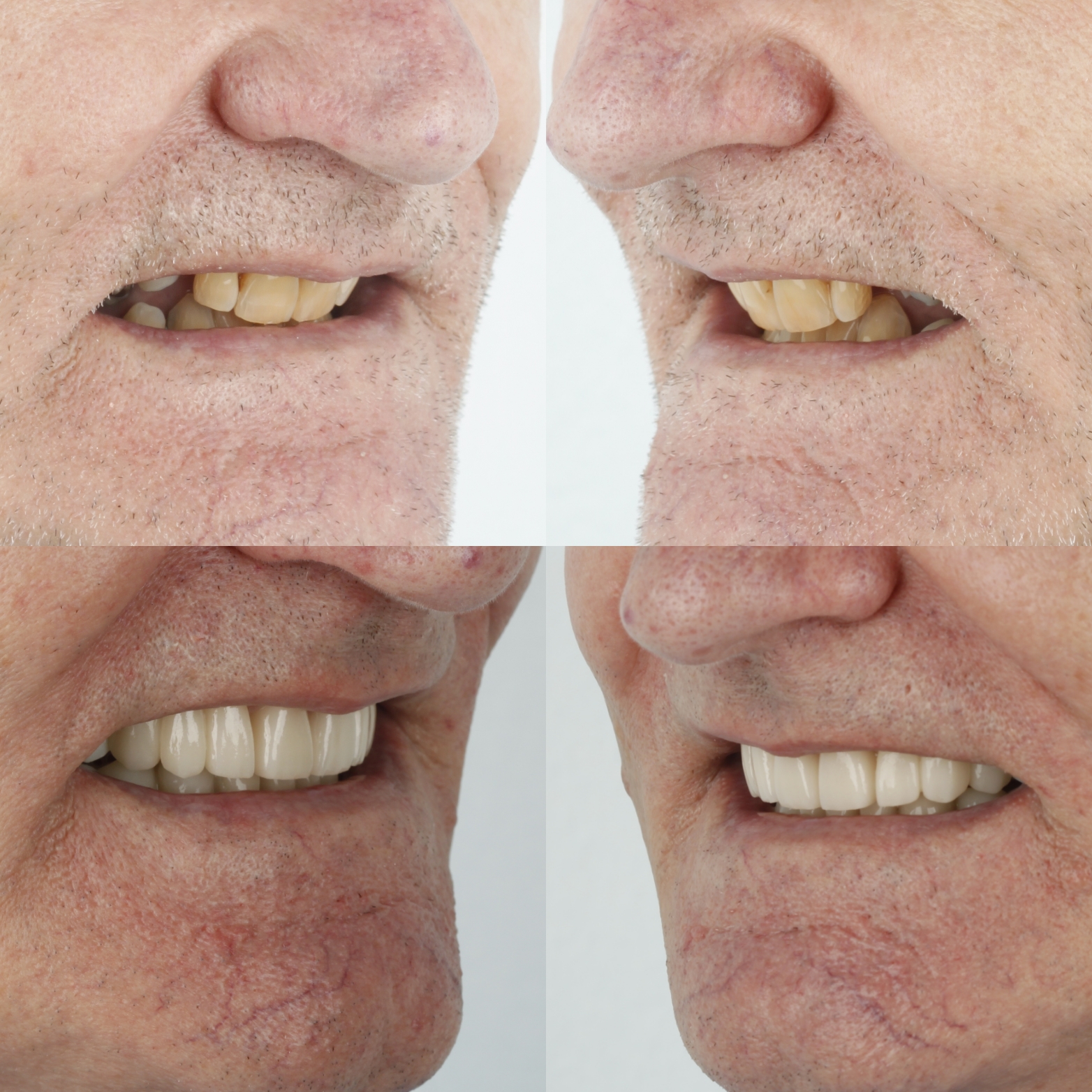 Full-Mouth Rehabilitation — case photo 3 at NIS Dental Image, Patong Phuket