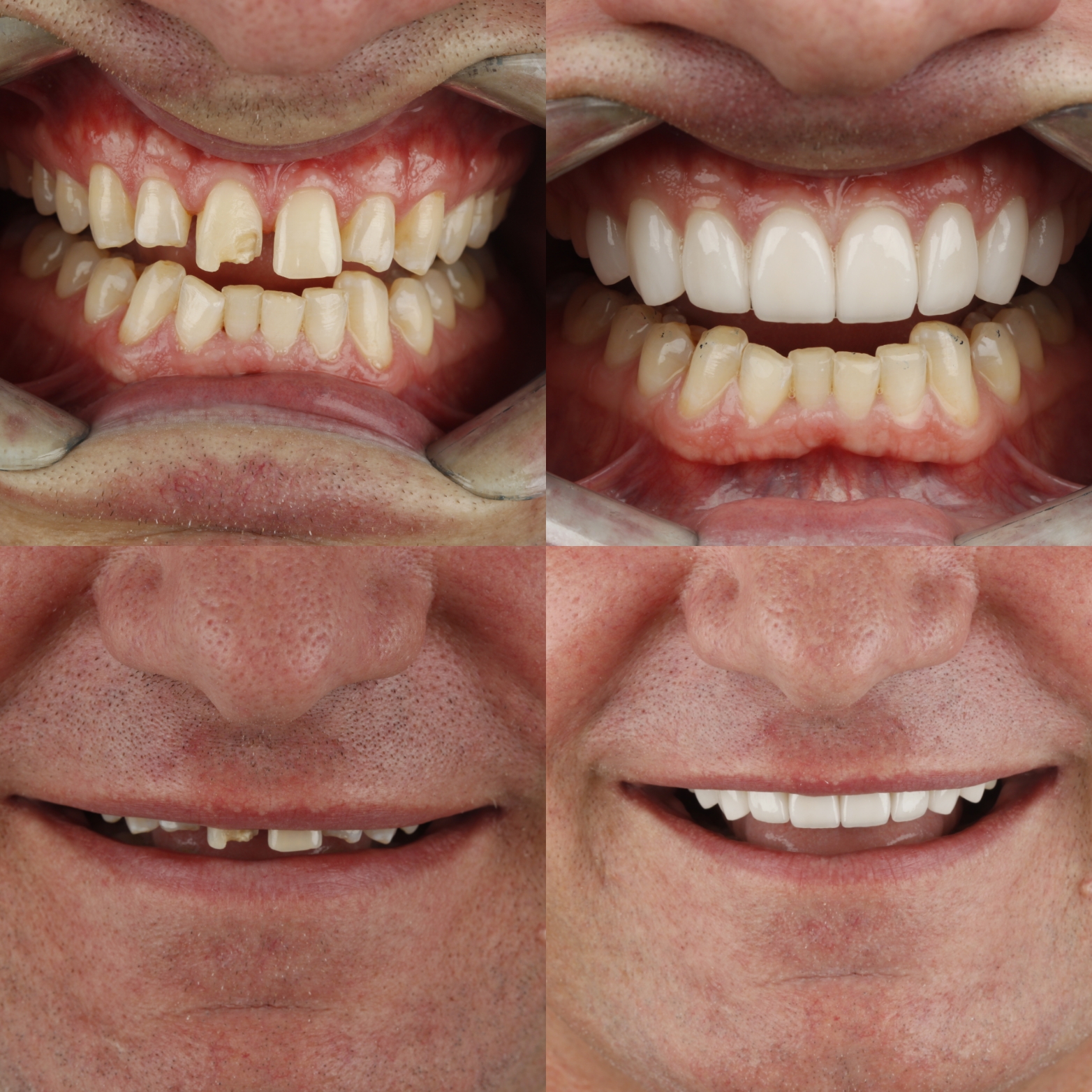 Dental Veneers — case photo 6 at NIS Dental Image, Patong Phuket