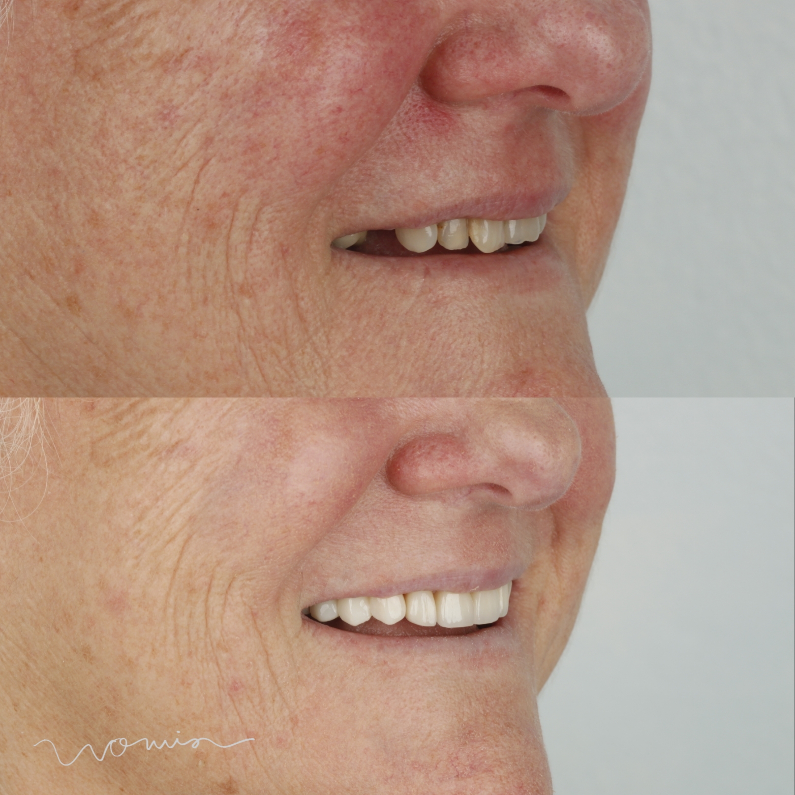 Dental Crowns & Bridges — case photo 3 at NIS Dental Image, Patong Phuket