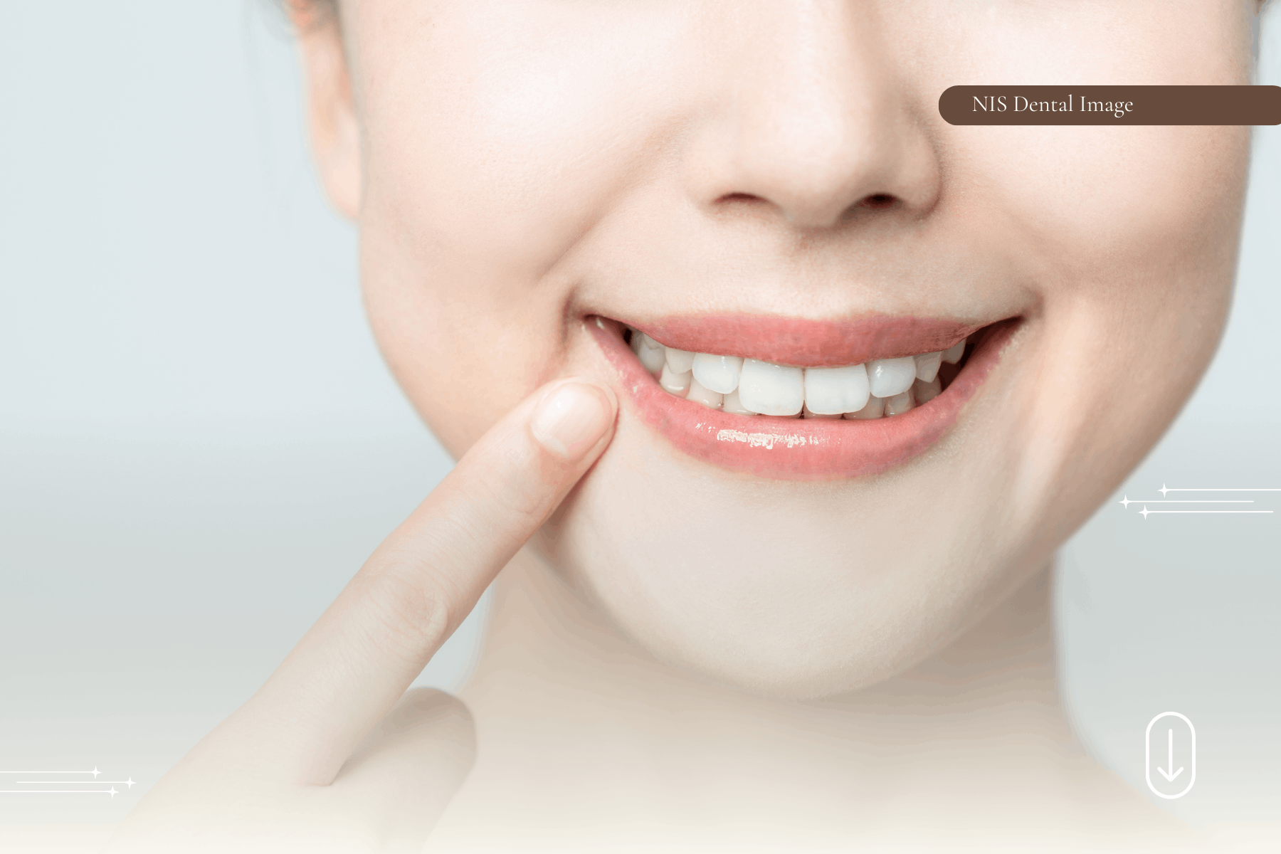 Dental Veneers in Phuket — How to Find the Right Clinic — case photo 3 at NIS Dental Image, Patong Phuket