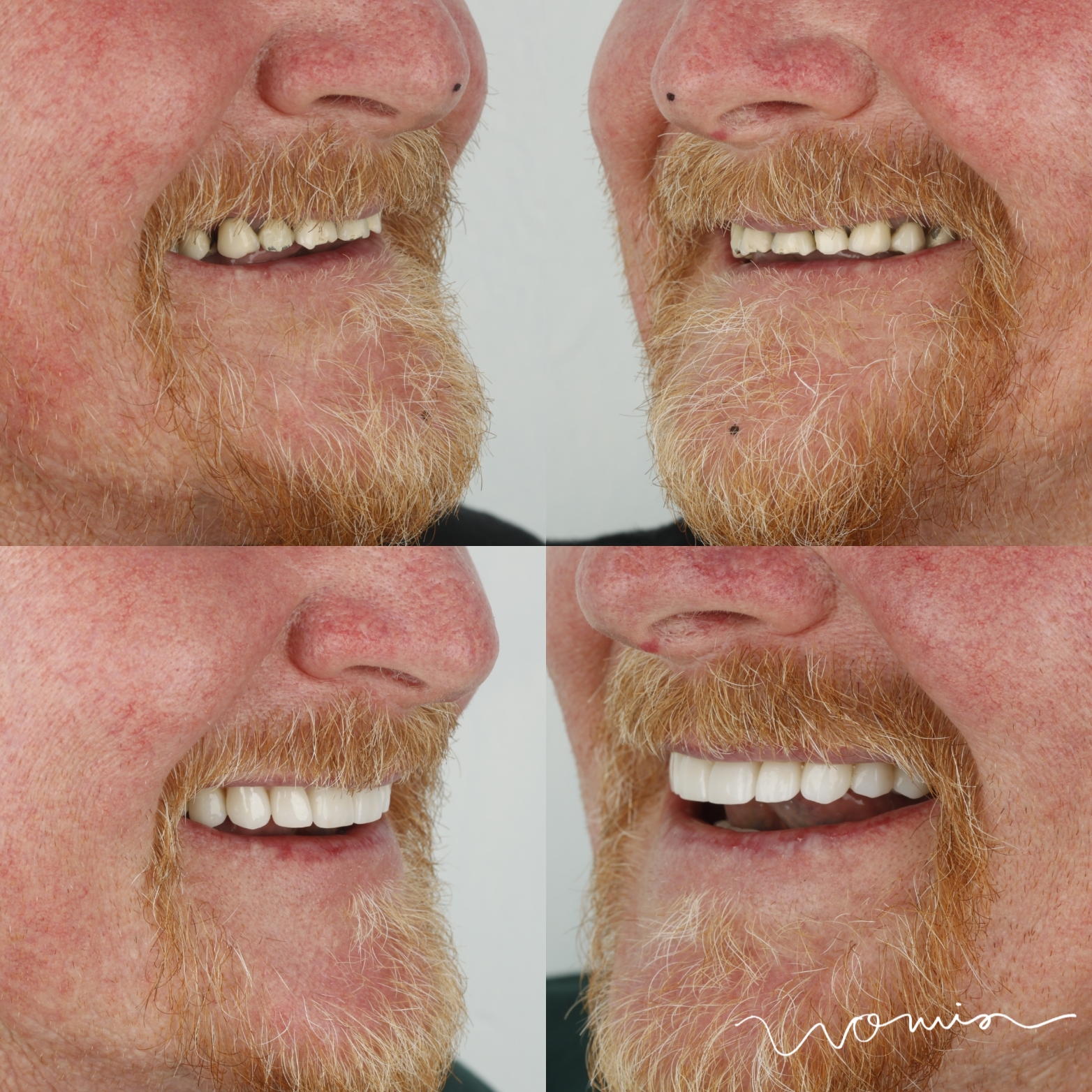 Full-Mouth Rehabilitation — case photo 7 at NIS Dental Image, Patong Phuket