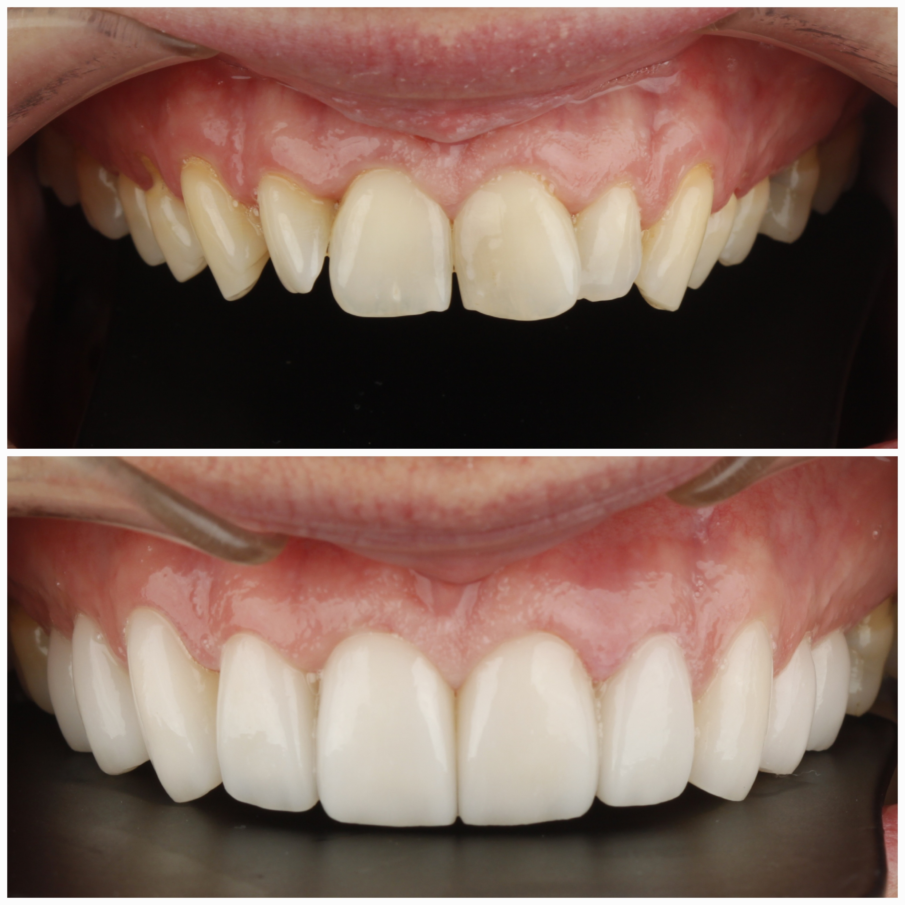 Dental Veneers — case photo 10 at NIS Dental Image, Patong Phuket