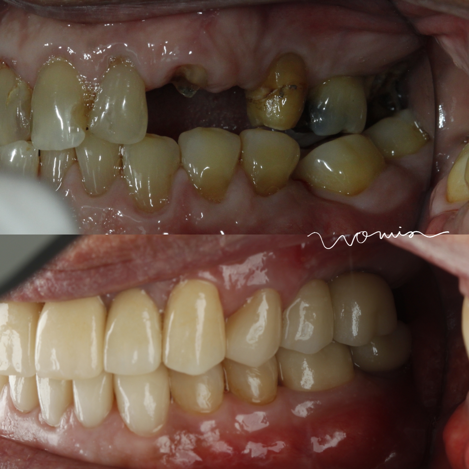 Full-Mouth Rehabilitation — case photo 2 at NIS Dental Image, Patong Phuket