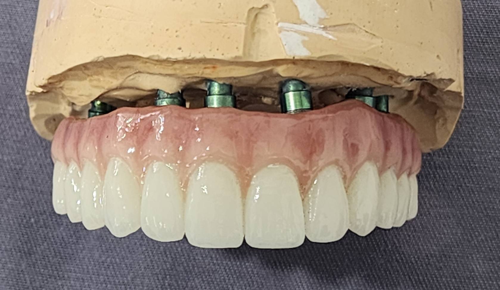 All-on-4 & All-on-6 Dental Implants — case photo 3 at NIS Dental Image, Patong Phuket