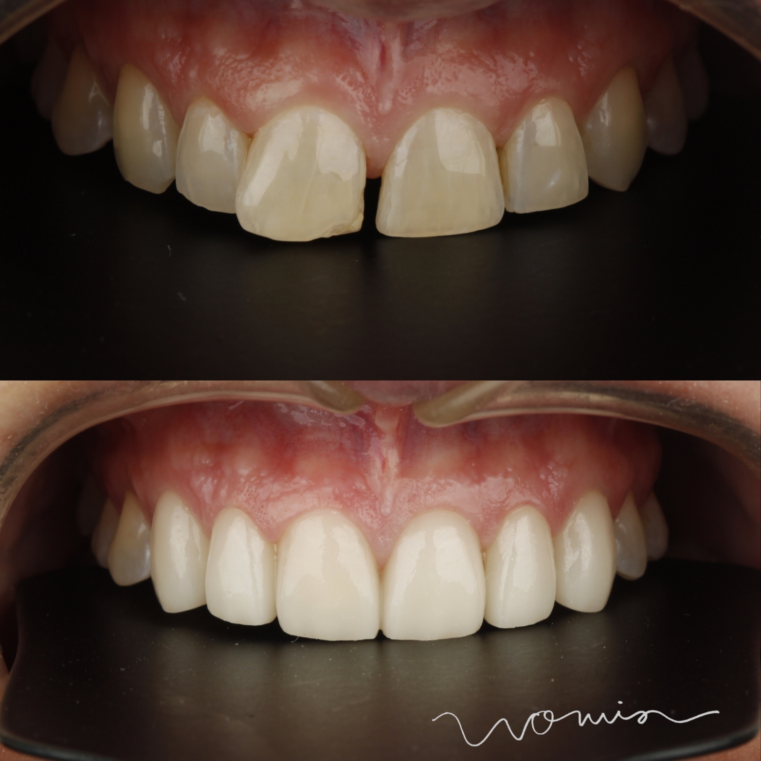 Dental Veneers — case photo 9 at NIS Dental Image, Patong Phuket