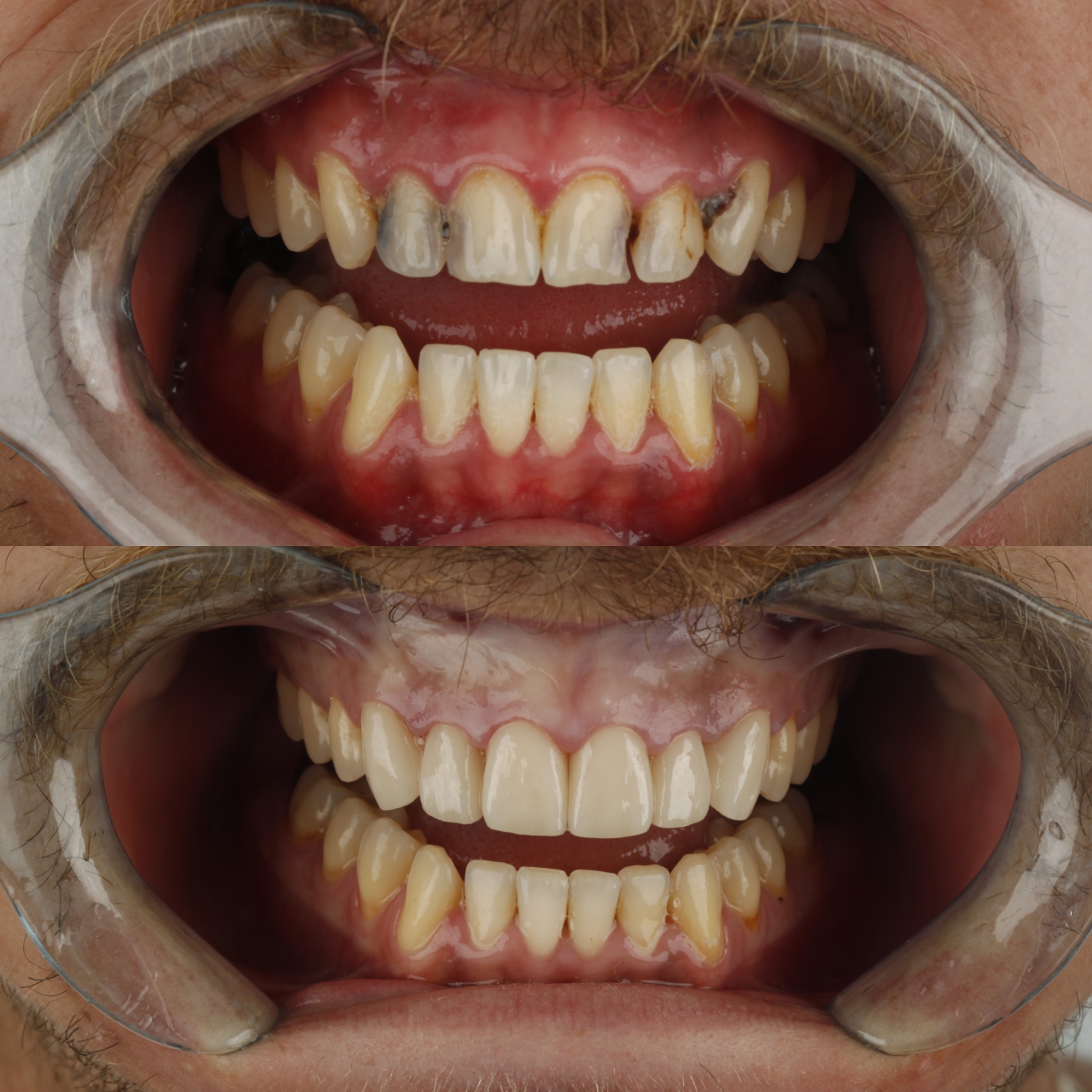 Dental Veneers — case photo 2 at NIS Dental Image, Patong Phuket