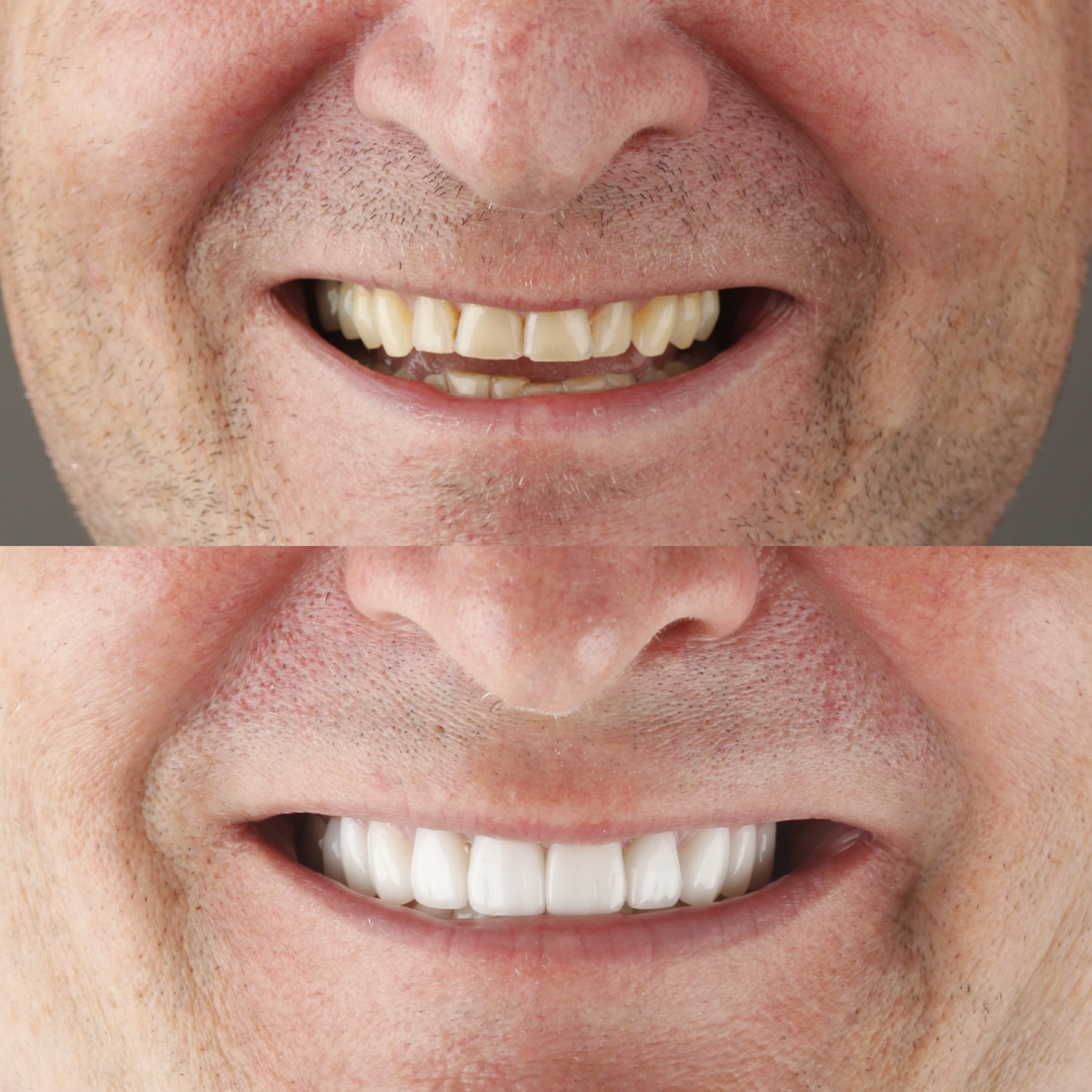 Dental Veneers — case photo 3 at NIS Dental Image, Patong Phuket