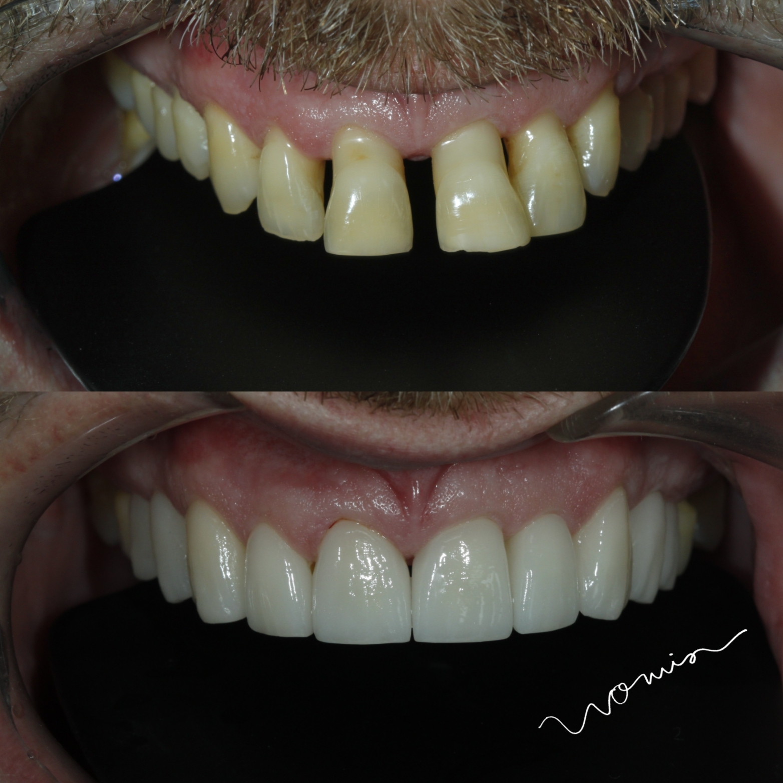 Dental Veneers — case photo 7 at NIS Dental Image, Patong Phuket