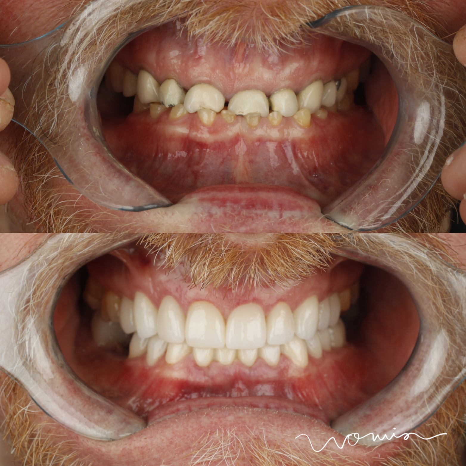 Full-Mouth Rehabilitation — case photo 11 at NIS Dental Image, Patong Phuket