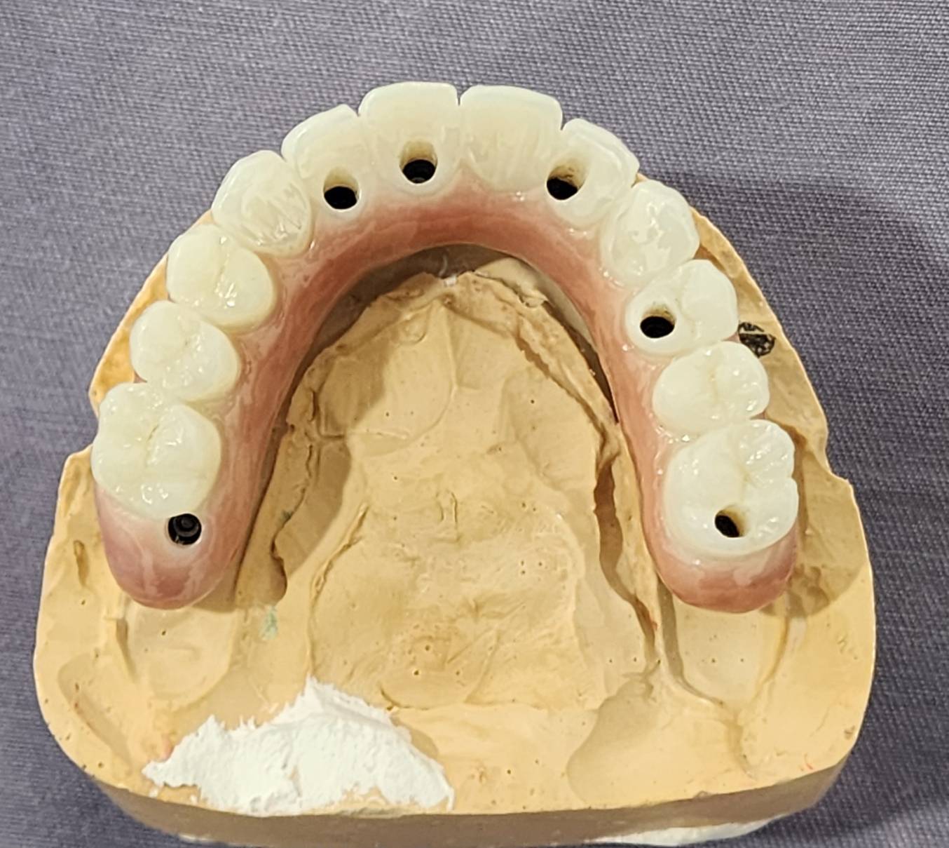 All-on-4 & All-on-6 Dental Implants — case photo 2 at NIS Dental Image, Patong Phuket