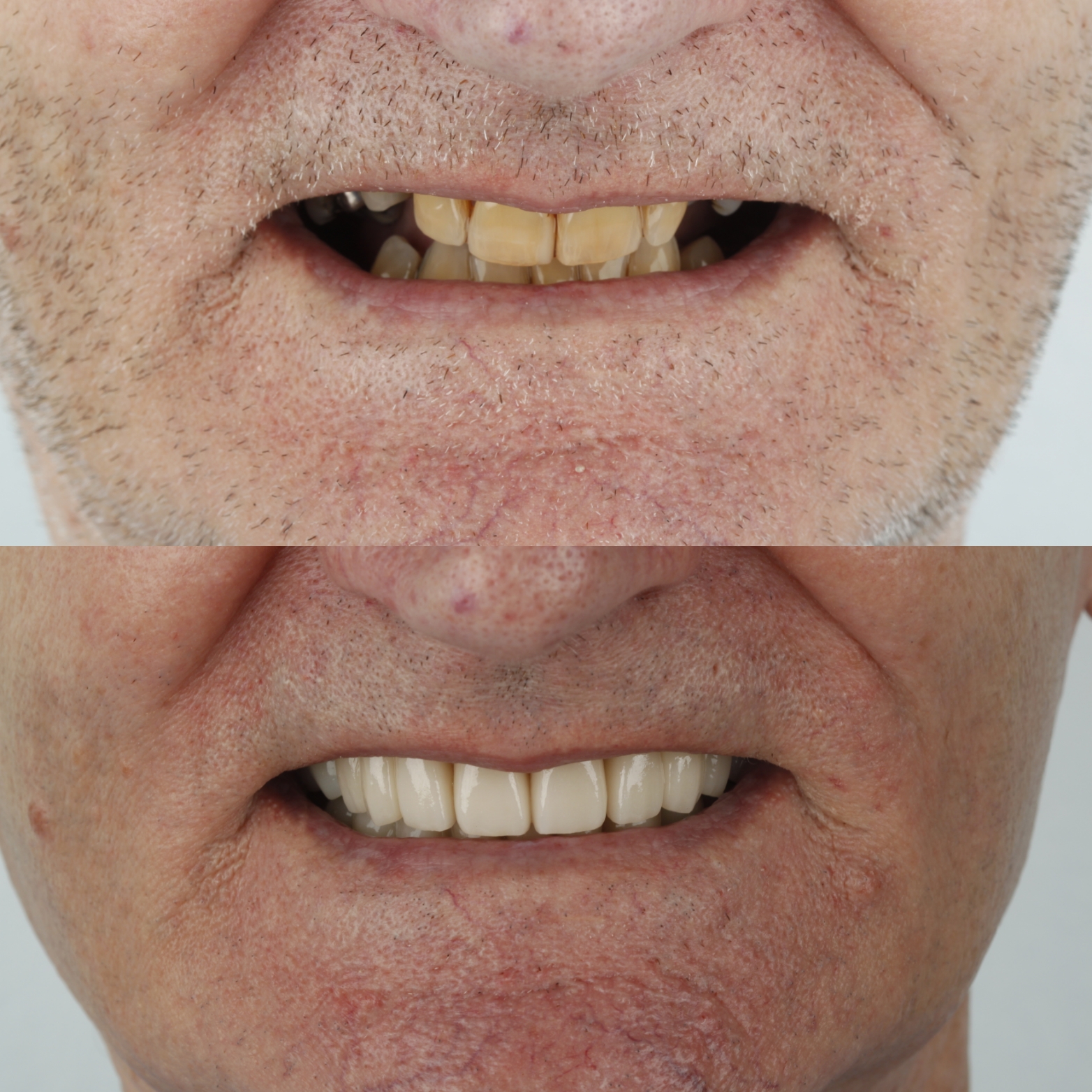 Full-Mouth Rehabilitation — case photo 6 at NIS Dental Image, Patong Phuket