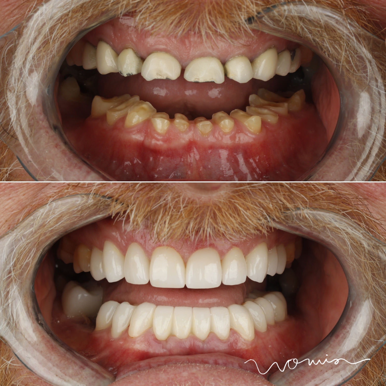 Full-Mouth Rehabilitation — case photo 8 at NIS Dental Image, Patong Phuket