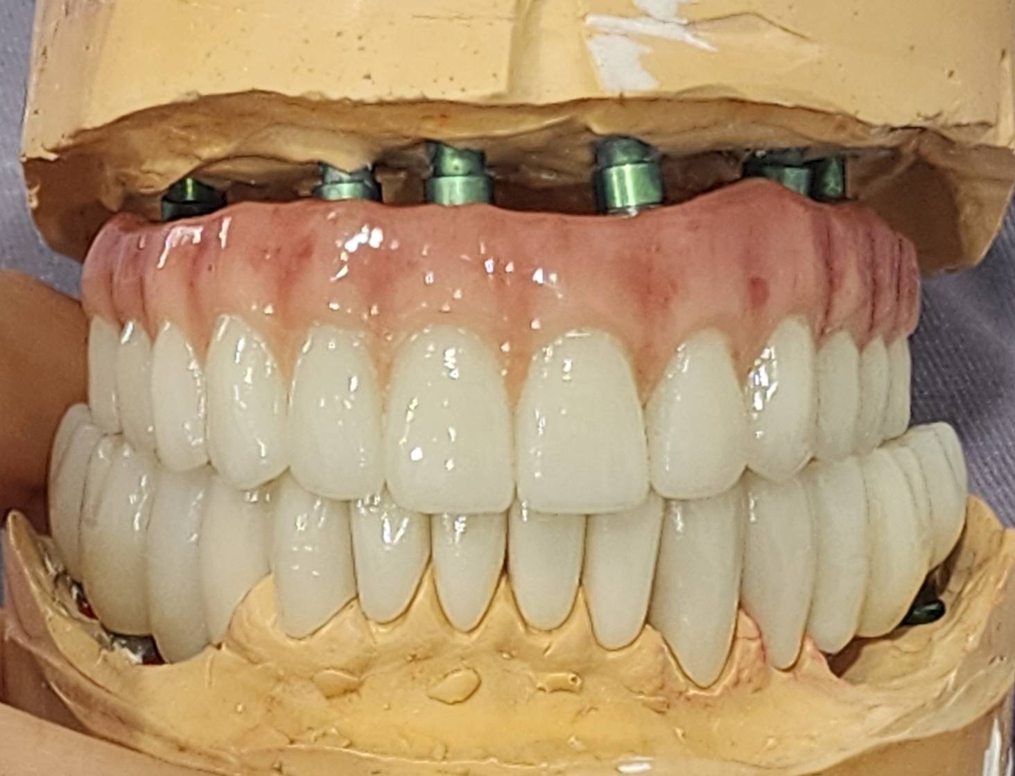 All-on-4 & All-on-6 Dental Implants — case photo 1 at NIS Dental Image, Patong Phuket