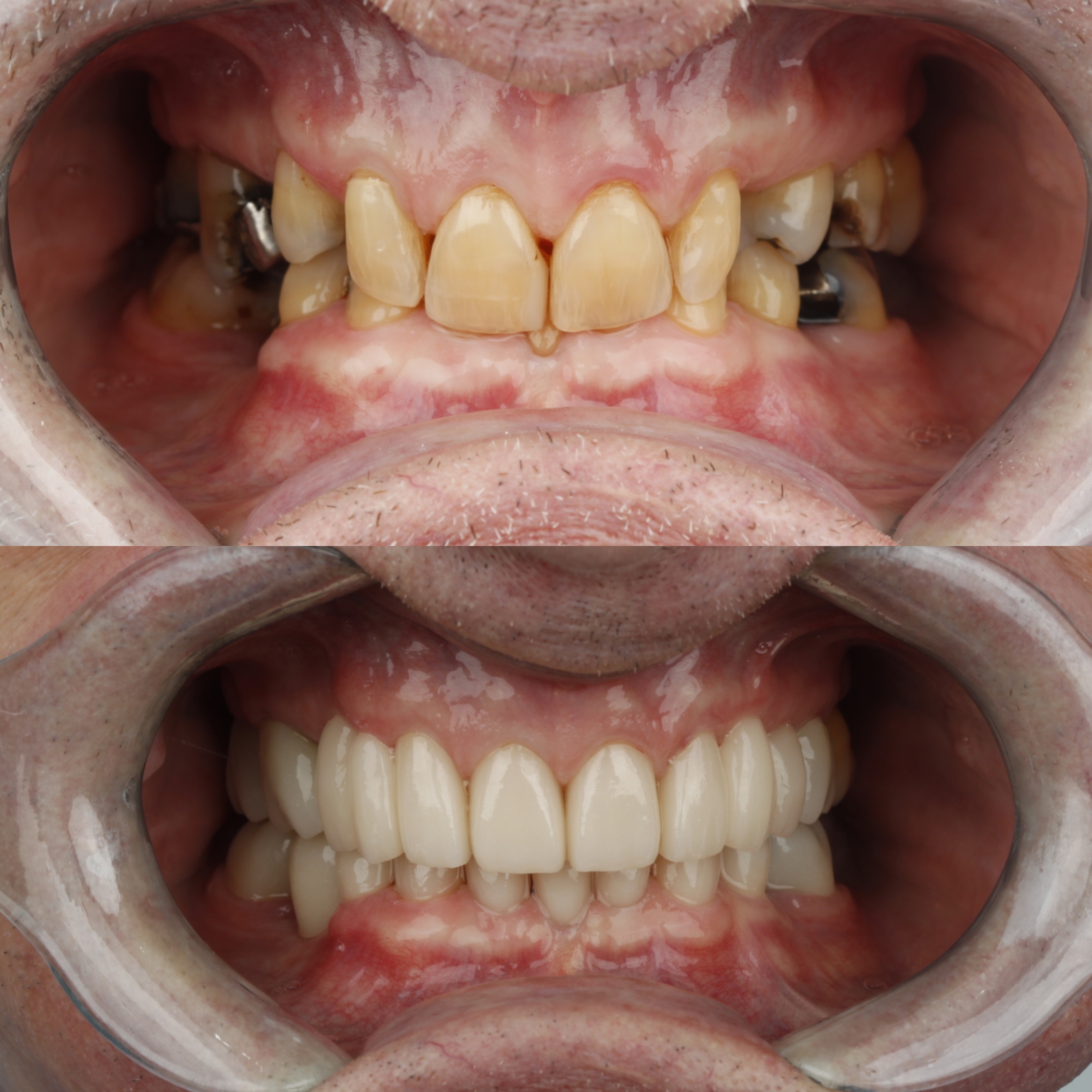 Full-Mouth Rehabilitation — case photo 5 at NIS Dental Image, Patong Phuket