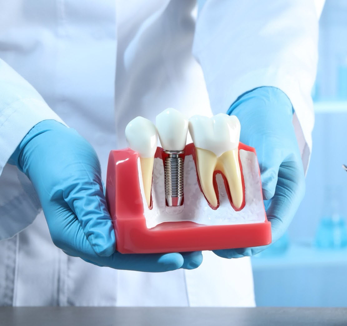 Teeth Whitening at NIS Dental Image, Patong Phuket