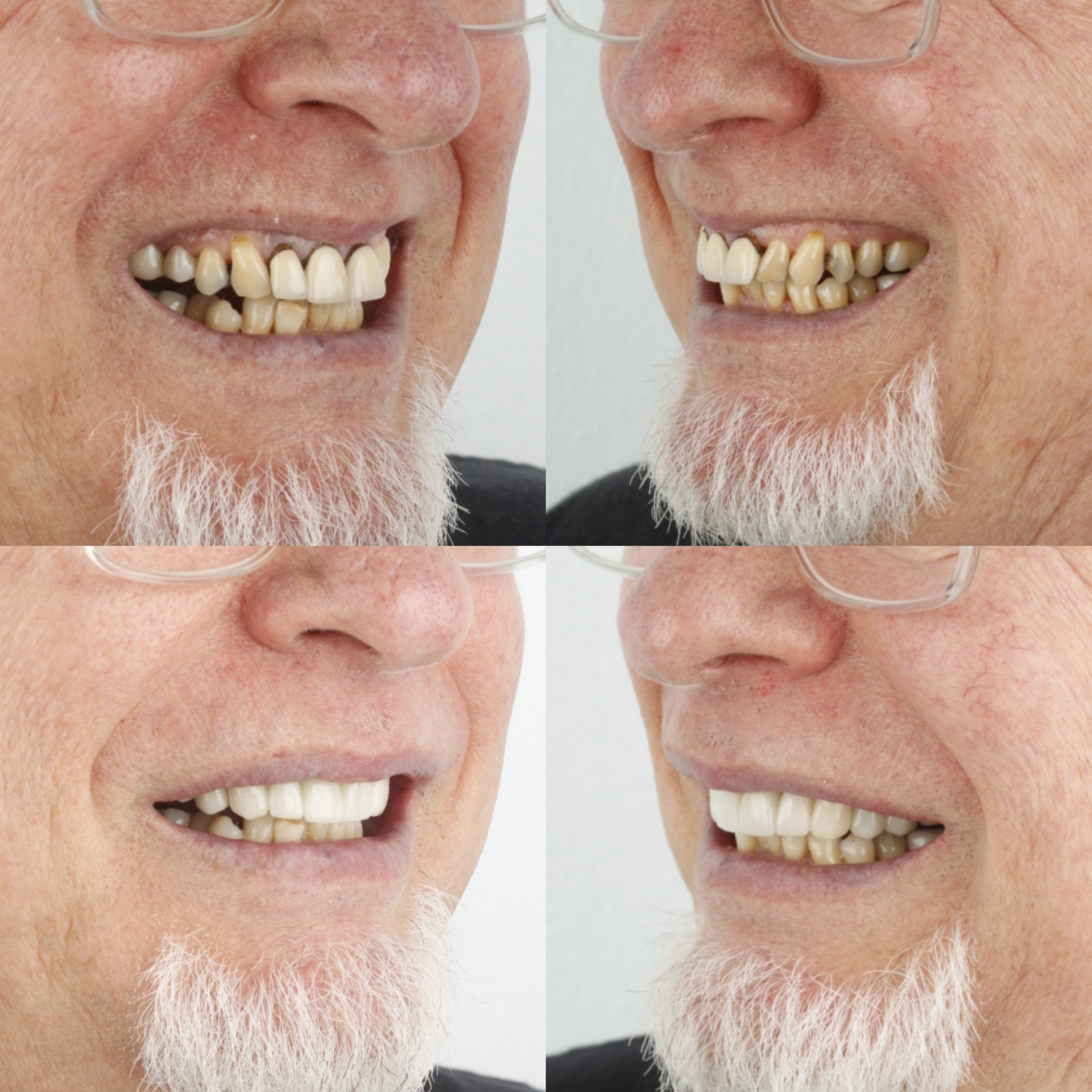 Dental Crowns & Bridges — case photo 5 at NIS Dental Image, Patong Phuket
