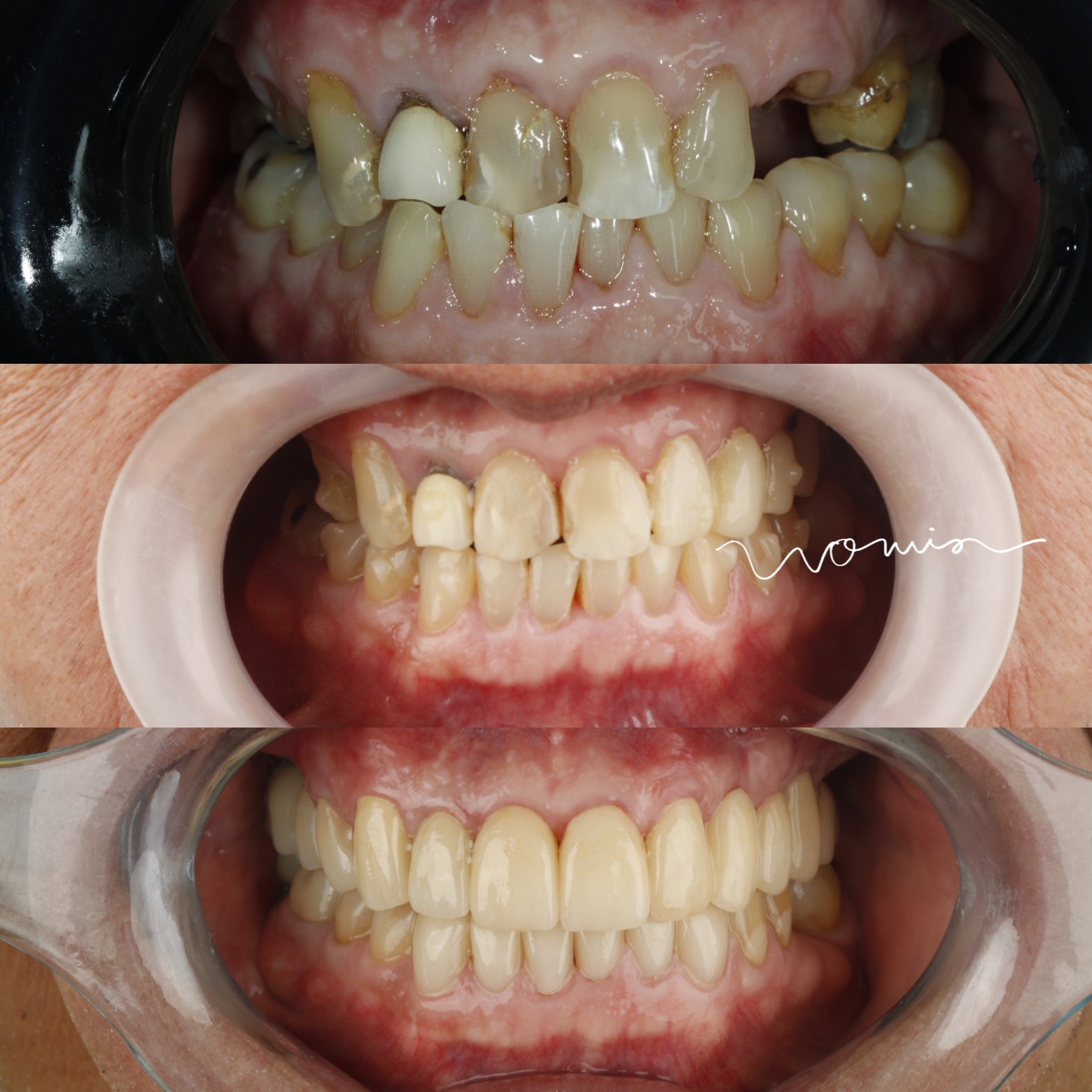 Full-Mouth Rehabilitation — case photo 10 at NIS Dental Image, Patong Phuket