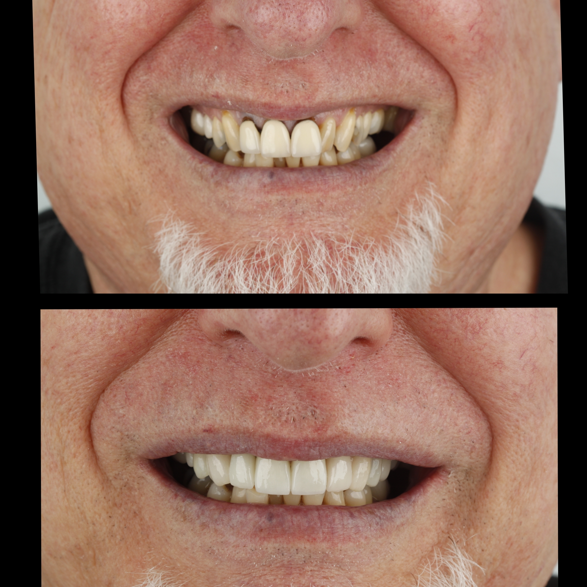Dental Crowns & Bridges — case photo 6 at NIS Dental Image, Patong Phuket
