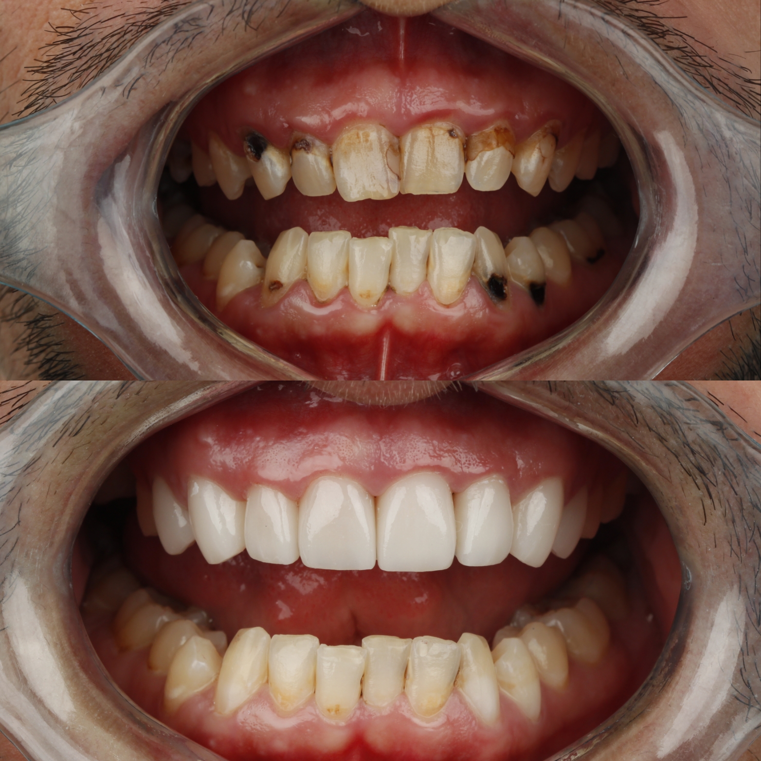 Dental Veneers — case photo 5 at NIS Dental Image, Patong Phuket