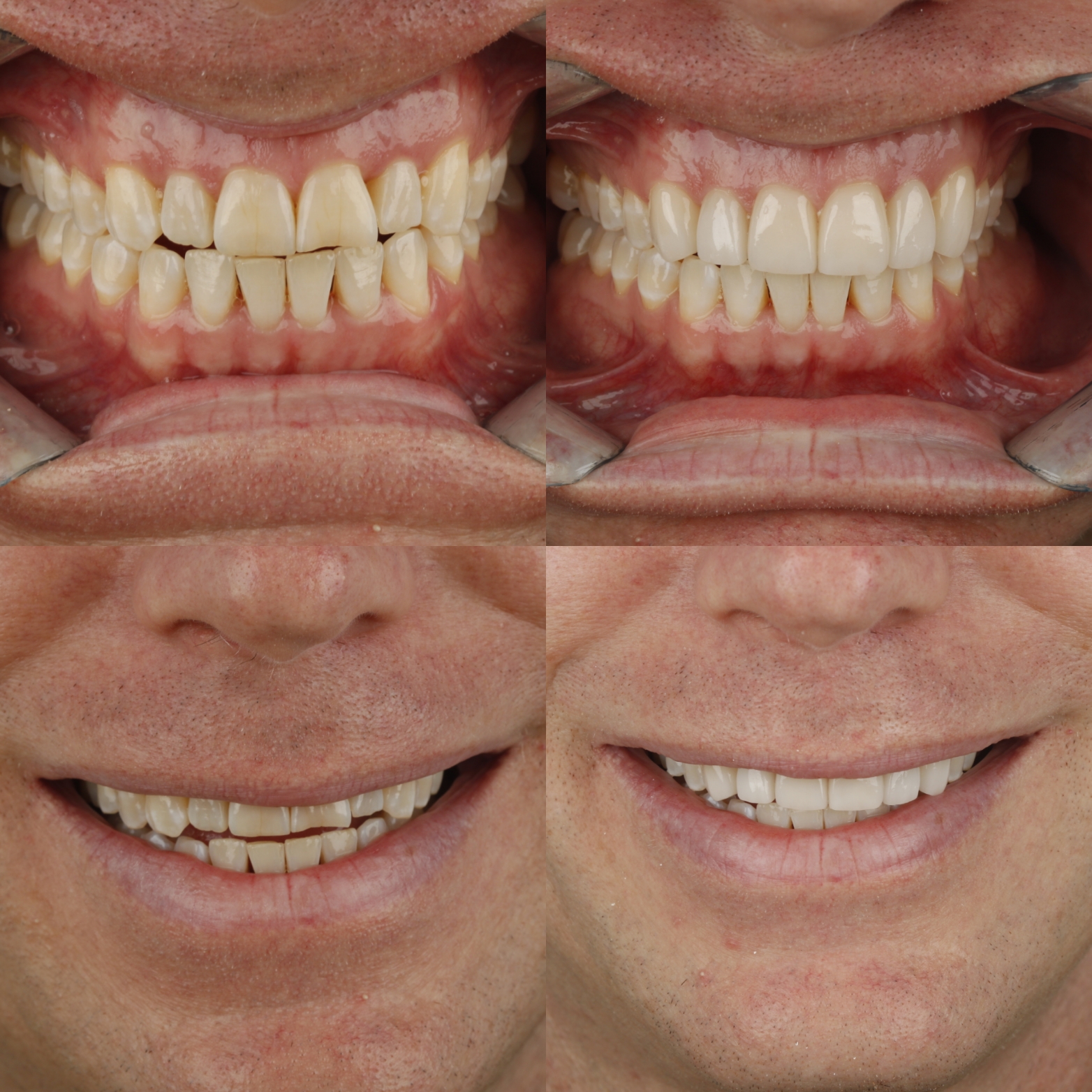 Dental Veneers — case photo 8 at NIS Dental Image, Patong Phuket