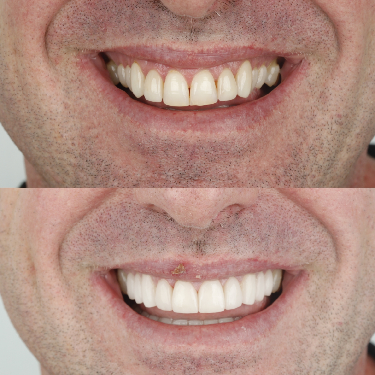Dental Veneers — case photo 4 at NIS Dental Image, Patong Phuket