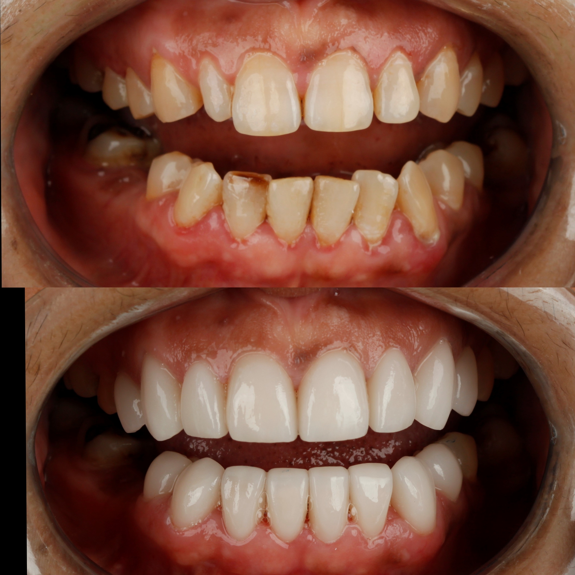 Dental Veneers — case photo 12 at NIS Dental Image, Patong Phuket