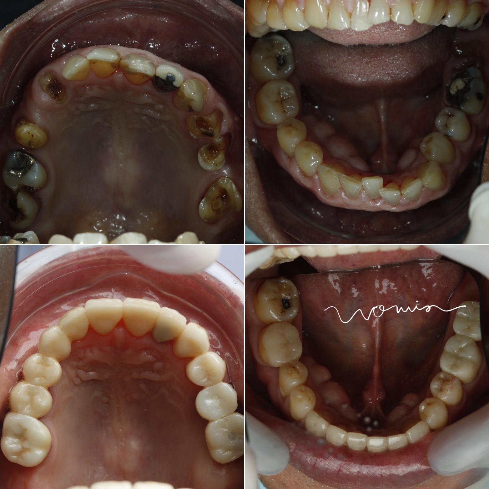 Full-Mouth Rehabilitation — case photo 1 at NIS Dental Image, Patong Phuket