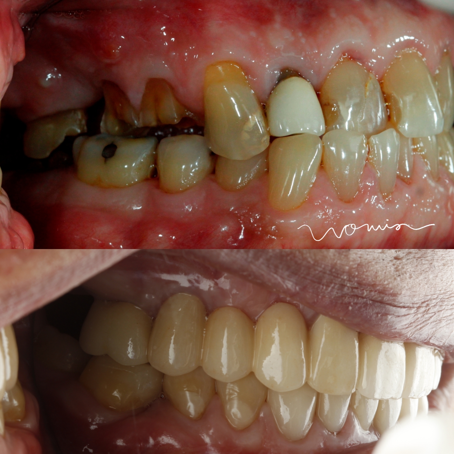 Full-Mouth Rehabilitation — case photo 9 at NIS Dental Image, Patong Phuket