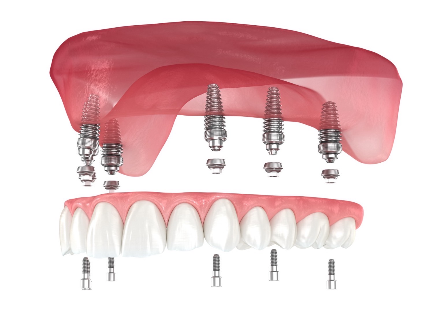All-on-4 & All-on-6 Dental Implants at NIS Dental Image, Patong Phuket