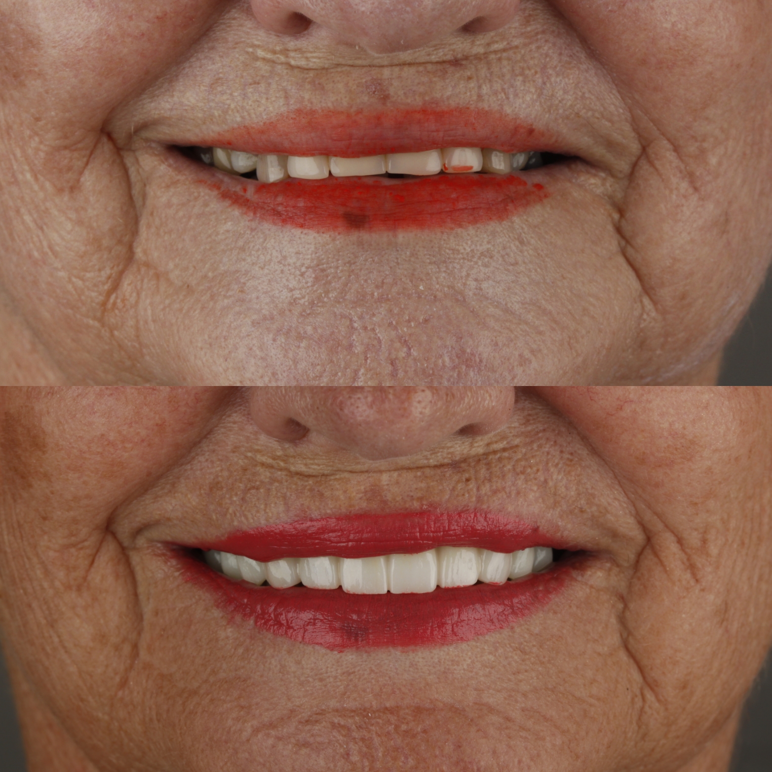 Dental Crowns & Bridges — case photo 4 at NIS Dental Image, Patong Phuket