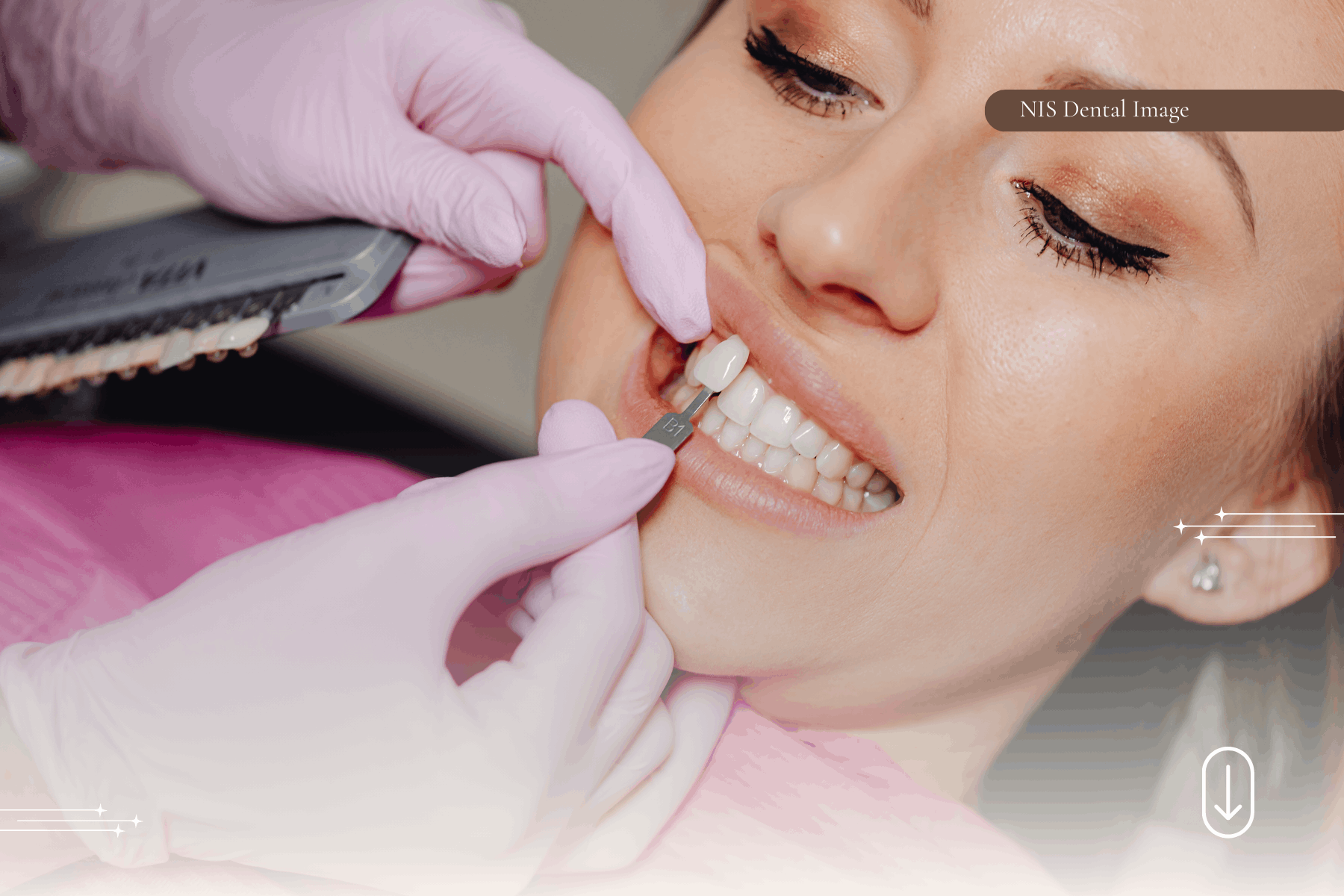 Dental Veneers in Phuket — How to Find the Right Clinic — case photo 2 at NIS Dental Image, Patong Phuket