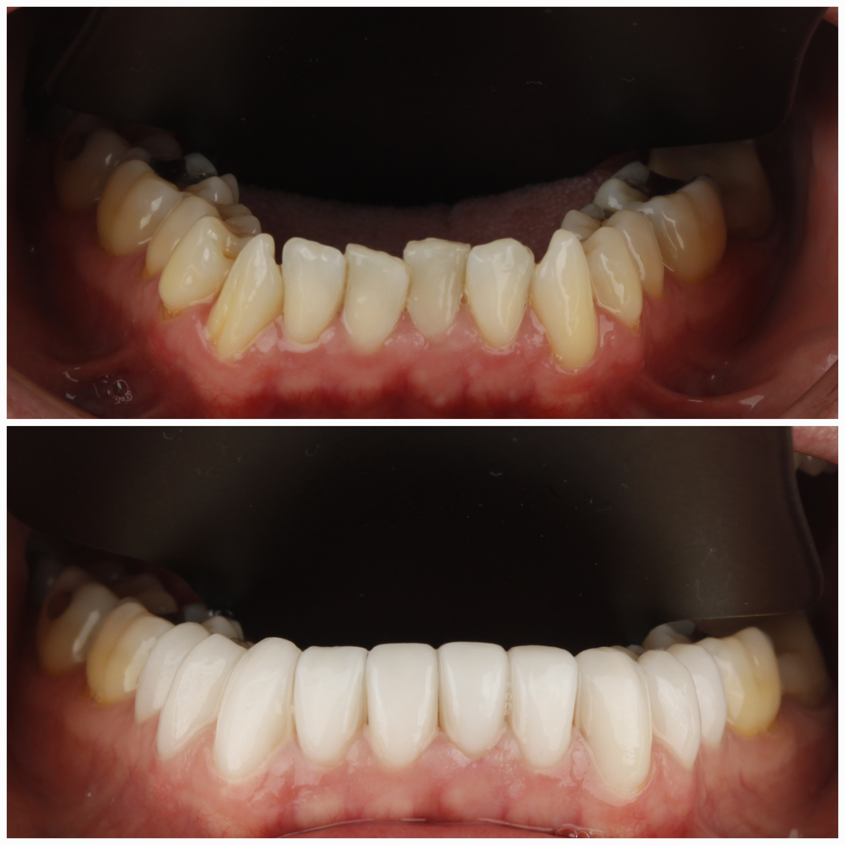 Dental Veneers — case photo 11 at NIS Dental Image, Patong Phuket
