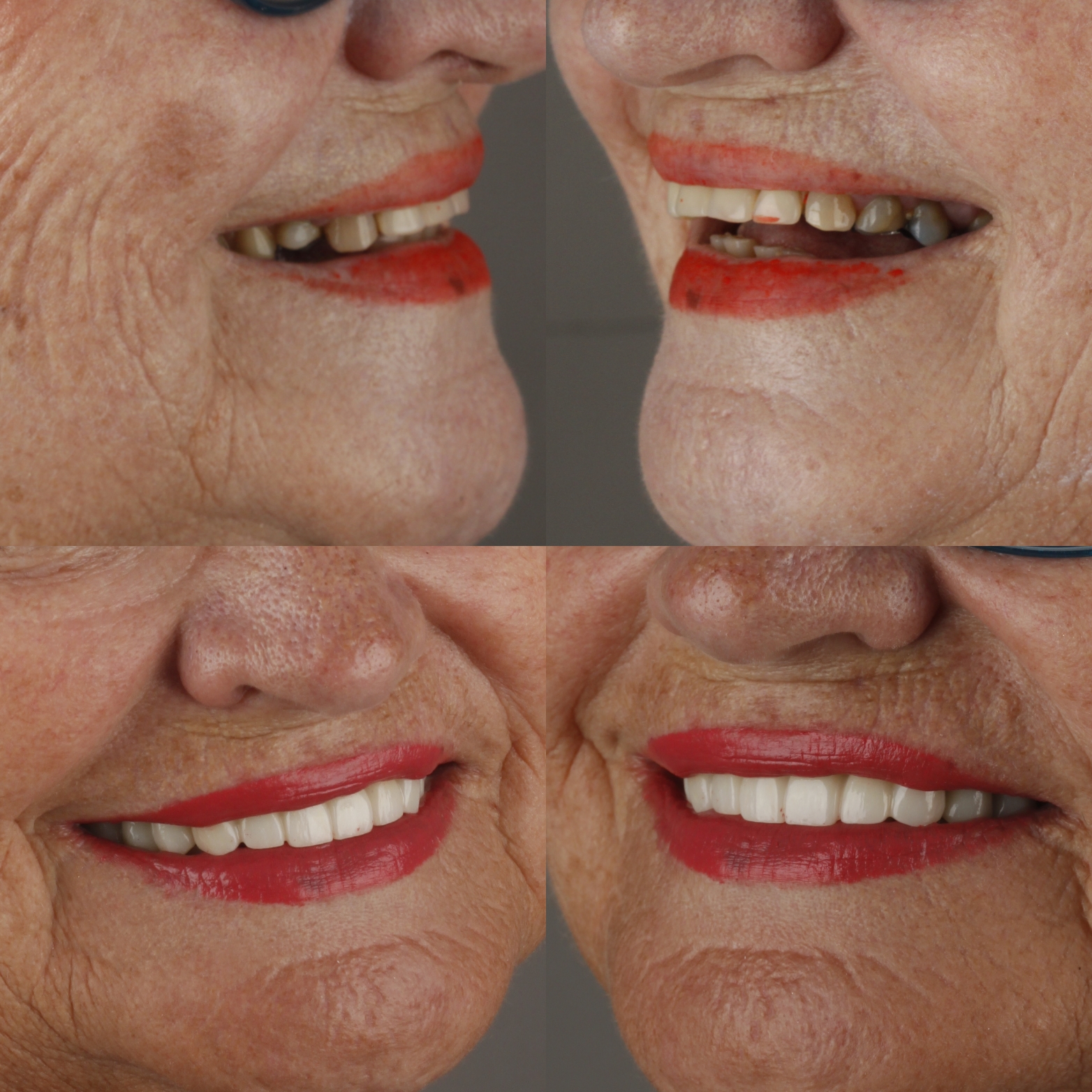 Dental Crowns & Bridges — case photo 2 at NIS Dental Image, Patong Phuket