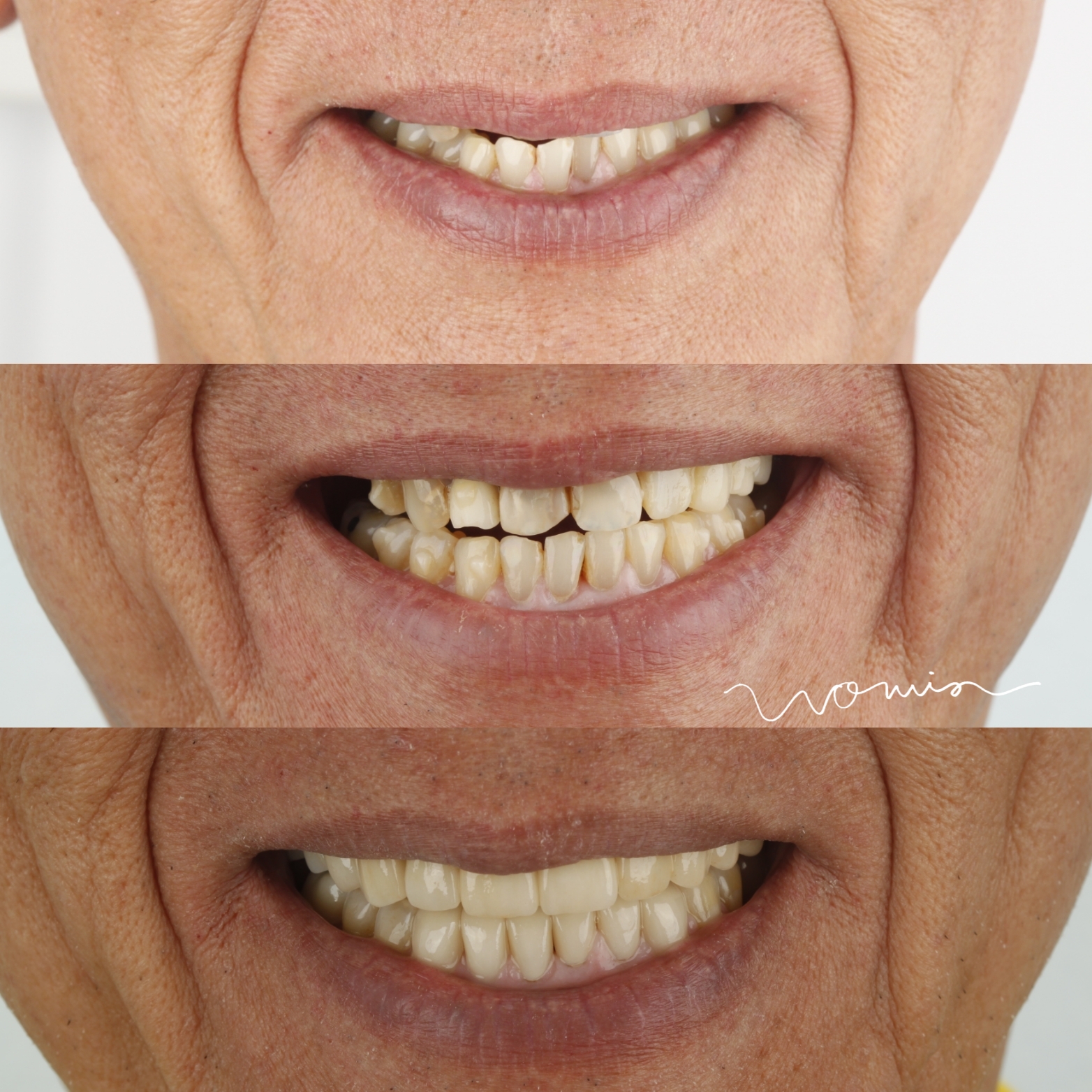 Full-Mouth Rehabilitation — case photo 4 at NIS Dental Image, Patong Phuket